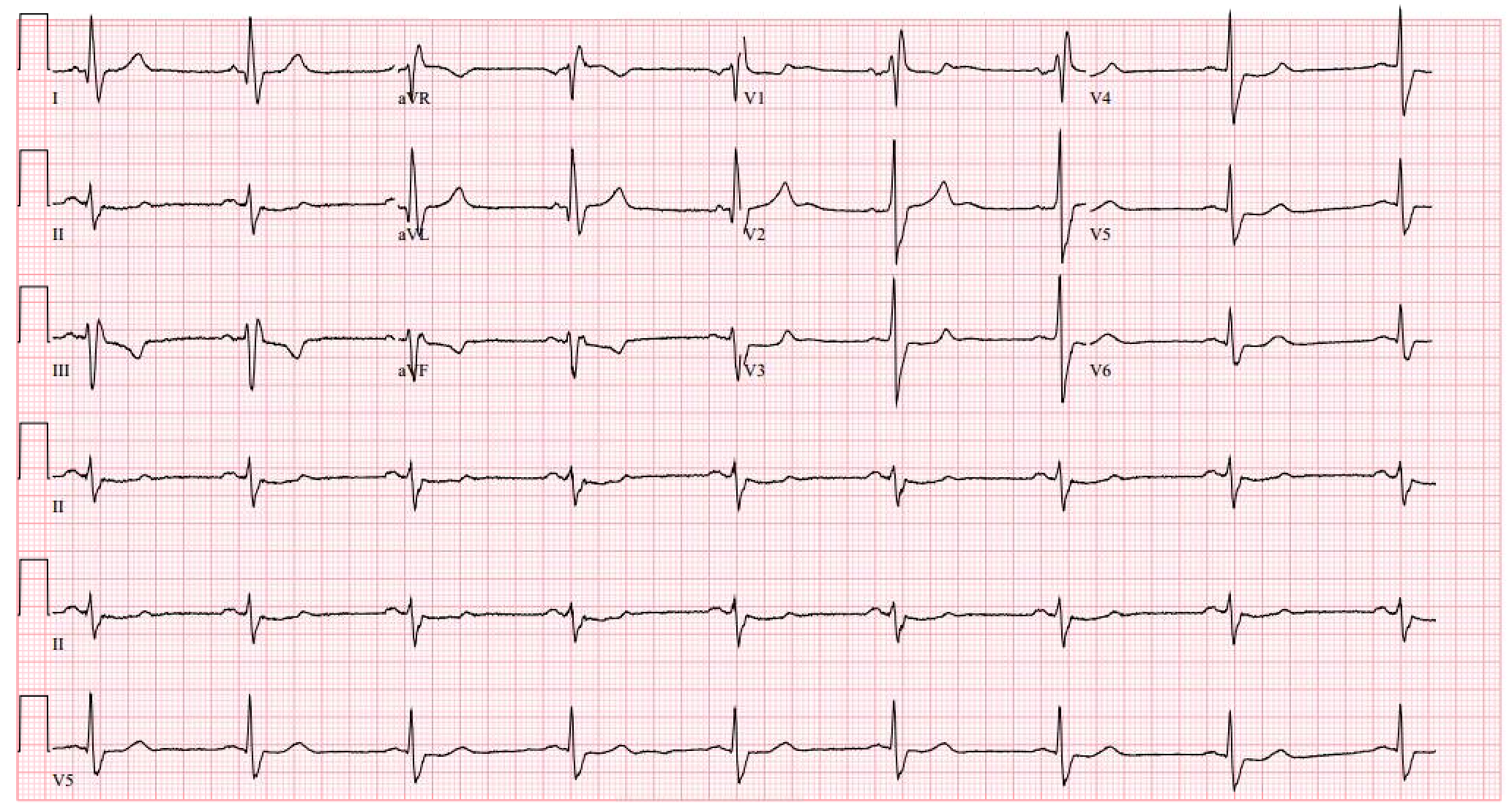 image result for ekg