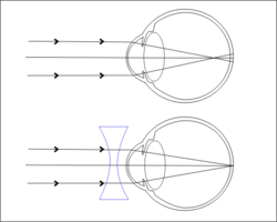 https://upload.wikimedia.org/wikipedia/commons/thumb/1/13/myopia.png/250px-myopia.png