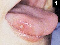 mucositis