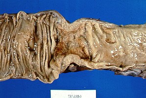 ../carcinoma%20colorrectal_archivos/ccr3.jpg