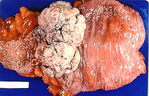 ../carcinoma%20colorrectal_archivos/ccr1.jpg