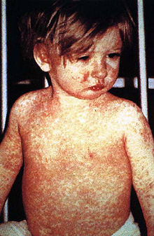 http://upload.wikimedia.org/wikipedia/commons/thumb/2/27/rougeoledp.jpg/220px-rougeoledp.jpg